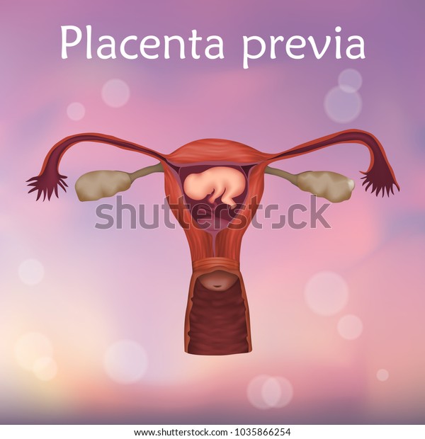 Placenta Previa Embryo Fetus Uterus Placenta Stock Vector Royalty Free 1035866254 Shutterstock