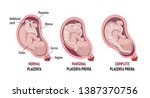 Placenta previa: normal , Partial, Marginal (Low-lying), Complete
