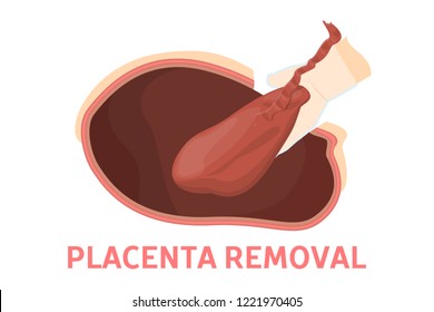 Placenta removal stage of birth via cesarean section. Fetus movement during the c-section. Biology and gynecology. Isolated vector illustration