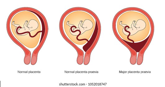 The placenta shown in the normal and alternate locations within the uterus