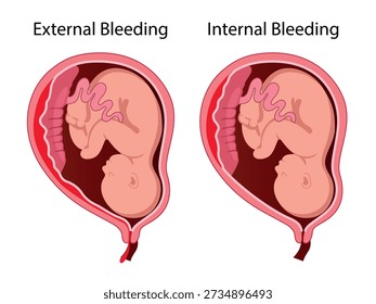 Placental abruption. Detachment of the placenta during pregnancy. Vector medical illustration
