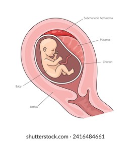 Placental abruption structure diagram hand drawn schematic vector illustration. Medical science educational illustration