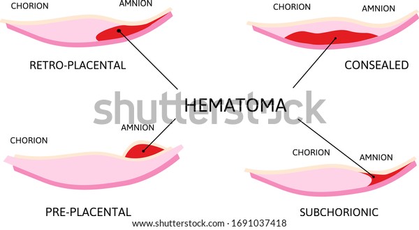 胎盤血腫 胎盤から血餅が出る 場所によっては レトロな胎盤 絨毛膜 胎盤前のもの 白い背景にベクター画像メディカルイラスト のベクター画像素材 ロイヤリティフリー