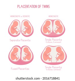 Placentación de la ilustración plana de mellizos