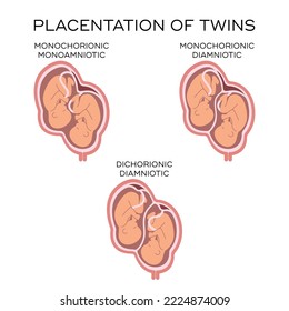 Placentation of twins. Flat vector illustration of multiple pregnancy variations - monozygotic, dizygotic, monoamniotic, diamniotic. Placenta, fetus, uterus. Maternity concept.