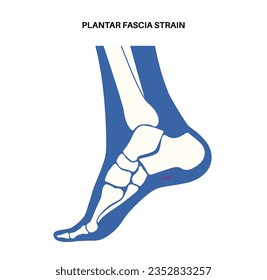 Plantar fascia strain anatomical poster. Tear of the soft tissue under the arch of a foot. Ankle disease treatment. Feet ligament injury. Feet pain and swelling. X ray examination vector illustration.