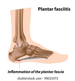 Plantar Fasciitis