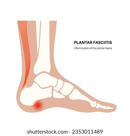 Plantar fasciitis anatomical poster. Stretches or tears of plantar fascia. Foot diseases treatment. Feet ligament inflammation. Ankle pain and swelling. X ray examination medical vector illustration.