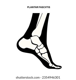 Plantar fasciitis anatomical poster. Stretches or tears of plantar fascia. Foot diseases treatment. Feet ligament inflammation. Ankle pain and swelling. X ray examination medical vector illustration.