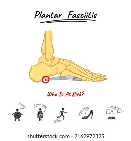 Plantar Fasciitis Anatomy Scheme Sketch Stock Vector (Royalty Free ...