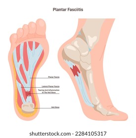 Plantar fasciitis. Plantar fascia inflammation or tearing. Disorder of connective ligament which supports the arch of the foot. Plantar heel pain syndrome. Flat vector illustration