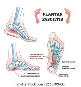 Plantar fasciitis as fascia muscle inflammation and tearing outline diagram. Labeled educational scheme with painful foot condition and medical xray explanation vector illustration. Feet skeleton.