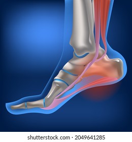 足底筋膜炎 のイラスト素材 画像 ベクター画像 Shutterstock