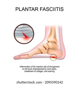 Plantar fasciitis. foot with the symptoms of plantar fasciitis. disorder of the connective tissue which supports the arch of the foot. close-up of tears of ligament. vector poster.