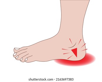 Plantar fasciitis. Heel pain. For medicine.