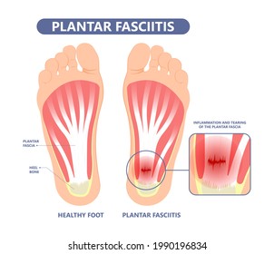 Plantar Fasciitis Heel pain run foot bone toes tear strain sport injury arch Shock Wave flat feet fallen pes planus Tendon tight hollow cavus high curved spur bony ankle band torn