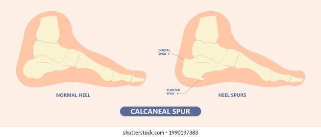 Plantar Fasciitis Heel pain run foot bone toes tear strain sport injury arch Shock Wave flat feet fallen pes planus Tendon tight hollow cavus high curved spur bony ankle band torn