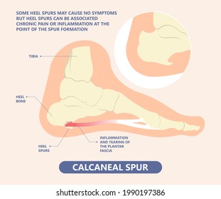 Plantar Fasciitis Heel pain run foot bone toes tear strain sport injury arch Shock Wave flat feet fallen pes planus Tendon tight hollow cavus high curved spur bony ankle band torn