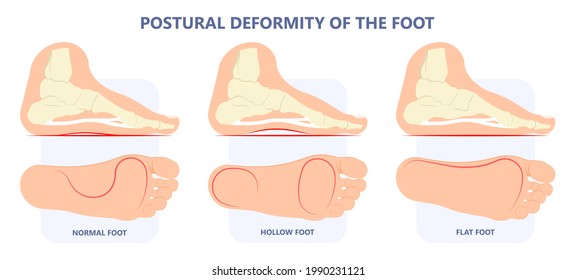 Plantar Fasciitis Heel pain run foot bone toes tear strain sport injury arch Shock Wave flat feet fallen pes planus Tendon tight hollow cavus high curved spur bony ankle band torn