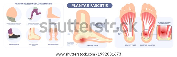 exostosis on top of foot