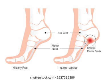 Fasciíte plantar é a inflamação na fáscia plantar é uma das queixas ortopédicas mais comuns.A fáscia plantar é um ligamento weblike espesso que conecta o calcanhar à frente do pé.Médico