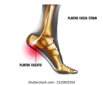 Plantar fasciitis inflammation and ruptures strain. Foot pain, realistic anatomy illustration