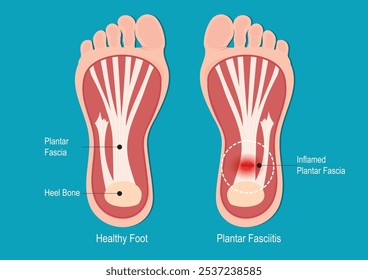 Fasciite plantar é uma das queixas ortopédicas mais comuns. causa dor na parte inferior do calcanhar.A fáscia plantar é um ligamento weblike espesso que conecta o calcanhar à frente do pé.Médico