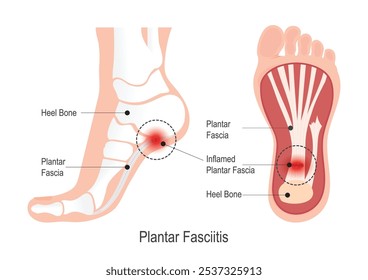 Plantar fasciitis is pain on the bottom of foot.The plantar fascia is a thick weblike ligament that connects heel to the front of foot.Medical healthcare.