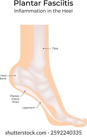 Plantar Fasciitis Science Design Vector Illustration Diagram