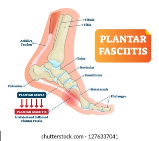 Plantar fasciitis vector illustration. Labeled human feet sport disorder diagram. Educational medical scheme with orthopedic leg disease. Painful plantar fascia inflammation and irritation infographic