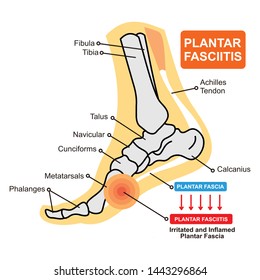 Plantar fasciitis vector illustration. Labeled human feet sport disorder diagram.