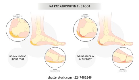 Plantar fat pad atrophy painful high heel ankle shoes bone spurs feet sport fascia arch of Lupus shots Steroid tear Achilles tendon