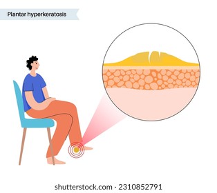 Plantar hyperhidrosis medical poster. Rough, thickened area of skin on the human feet. Dermatology clinic banner with swollen painful skin. Dead cells on epidermis level flat vector illustration