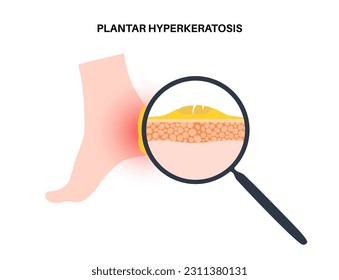 Plantarhyperhidrosis medizinisches Poster. Starke, verdickte Hautfläche auf den menschlichen Füßen. Klinikbanner mit geschwollener schmerzhafter Haut. Tote Zellen auf Epidermis-Ebene flache Vektorgrafik