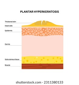 Plantarhyperhidrosis medizinisches Poster. Starke, verdickte Hautfläche auf den menschlichen Füßen. Klinikbanner mit geschwollener schmerzhafter Haut. Tote Zellen auf Epidermis-Ebene flache Vektorgrafik