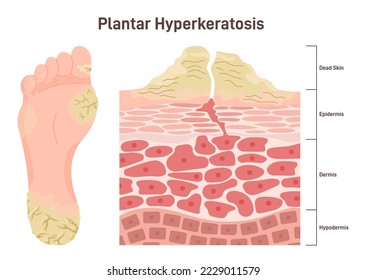 Plantar hyperkeratosis. Feet corns and calluses, medical condition with thickening of the outer layer of the skin. Flat vector illustration