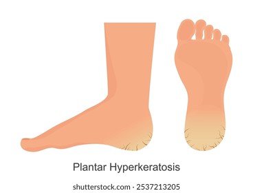 Plantar Hyperkeratosis ist Keratin Überwuchs wirkt sich häufig auf den Fuß Boden.Keratin kann sich aufbauen, ein Zustand, wo die verdickte Haut auf dem Fuß wird hart und rissig.