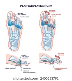 Anatomía de lesiones en placas plásticas y esquema de trauma roto en cápsulas de pie. Esquema educativo etiquetado con problema de pie esquelético e ilustración vectorial de desviación de pies. Enfermedad del ligamento colateral.