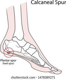 Plantar spur (calcaneal spur). Human foot bones. Vector illustration Isolated on a white background