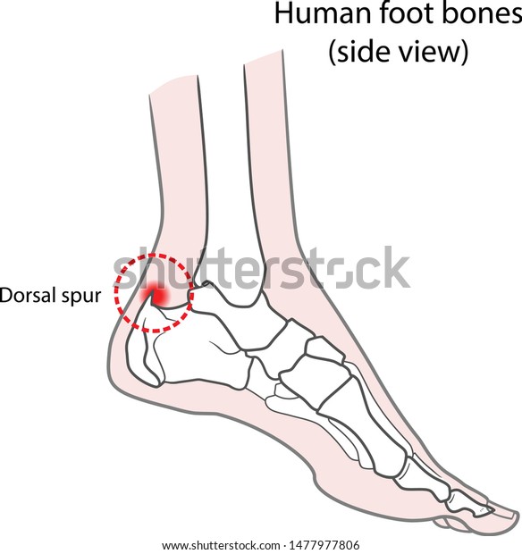 Stock Vektor „plantar Spur Calcaneal Spur Human Foot“ Bez Autorských Poplatků 1477977806