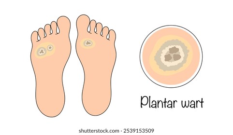 Plantarwarze. Warzen, die durch humane Papillomaviren verursacht werden, die auf den Sohlen oder Zehen auftreten. Medizinische Darstellung, die die Manifestation der Krankheit auf der Haut der Beine widerspiegelt. 