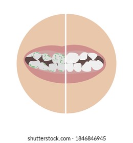 Plaque disclosure tablets at work. Before and after - the effect. White healthy teeth and teeth with green plaque, bacteria, virus. Plaque pill concept