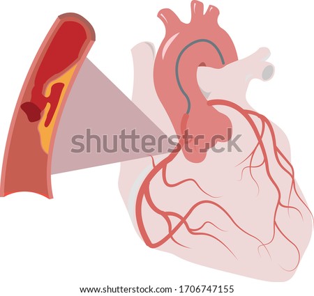 Plaque rupture in a patient with heart attack and acute myocardial infarction