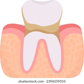 Plaque Tooth Problem Vector Illustration