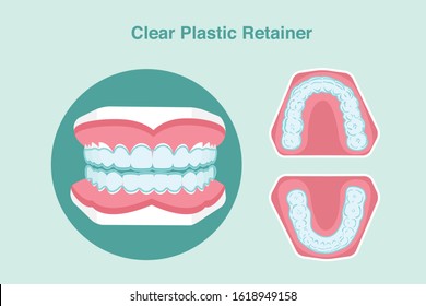  Clear Plastic Retainer with teeth model isolated on blue background,vector illustration
