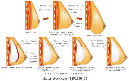 Plastic surgery of breast. Diagram about method of insertion for breast implant. Cosmetic surgery illustration. Anatomy of the breast and implants. The rise and increase of breast plastic surgery