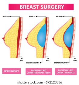plastic surgery of breast implant before and after vector illustration