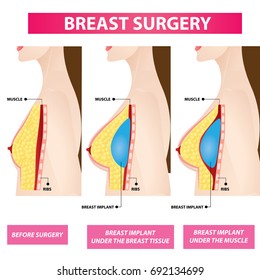 Breast Implant Size Chart