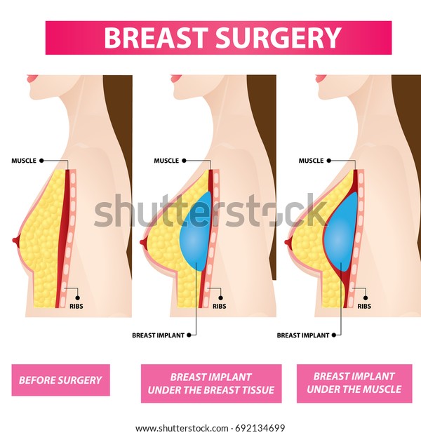 plastic surgery before and after breast