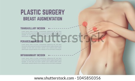 Plastic surgery of breast implants. Illustration shows incision methods.